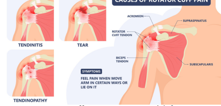 Rotator-Cuff-tear-Causes-Risk-factors