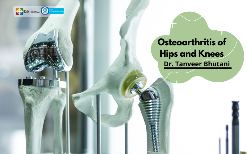 Osteoarthritis of Hips and Knees