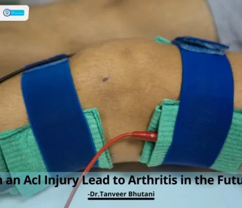 Can-an-Acl-Injury-Lead-to-Arthritis-in-the-Future