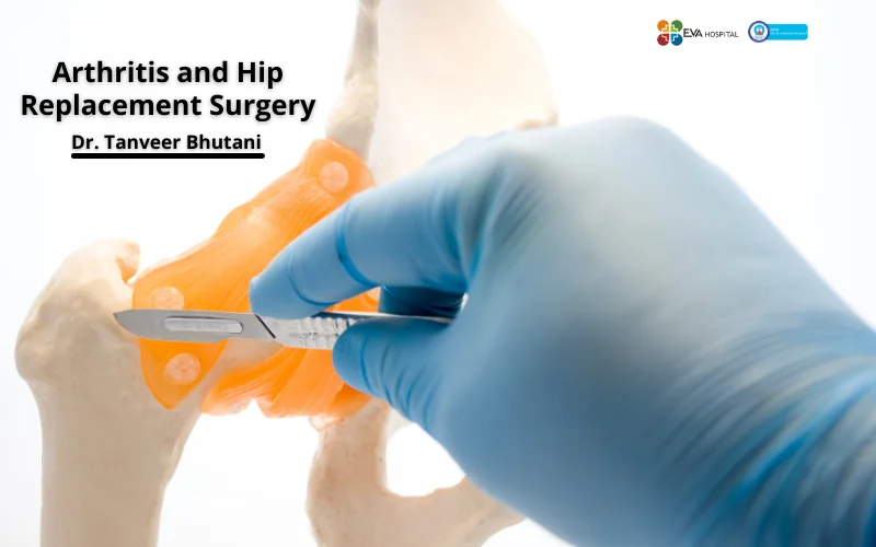 Arthritis and Hip Replacement Surgery