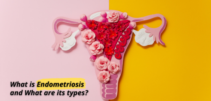 Eva-What-is-Endometriosis-and-What-are-its-types