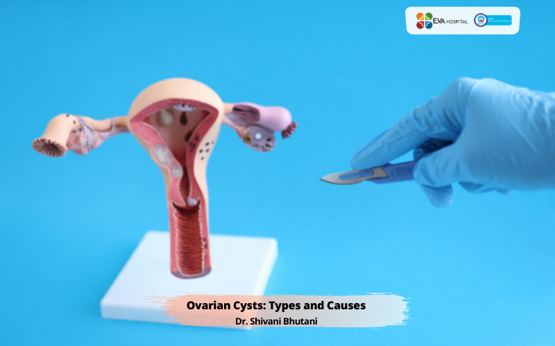 Ovarian-Cysts-Types-Cause.