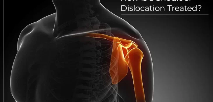 How-is-shoulder-dislocation-treated