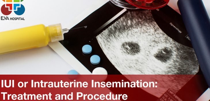 IUI or Intrauterine Insemination: Treatment and Procedure