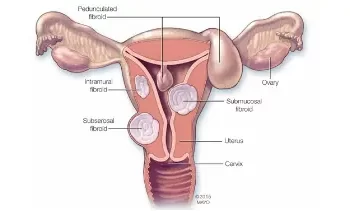 Fibroid-Treatment