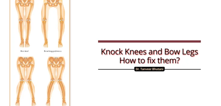 Knock-Knees-and-Bow-Legs-How-to-fix-them