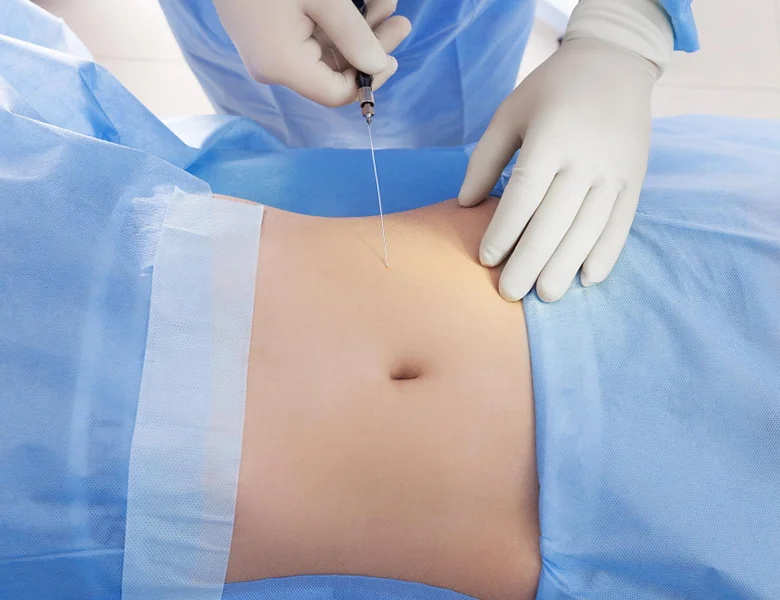 What-is-Abdominal-Hysterectomy
